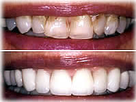 Veneers